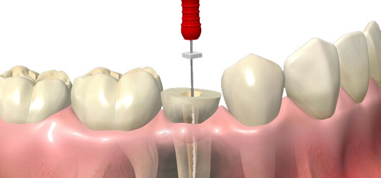 es endodoncia blog es endodoncia blog
