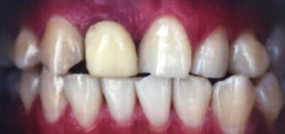 Antes
